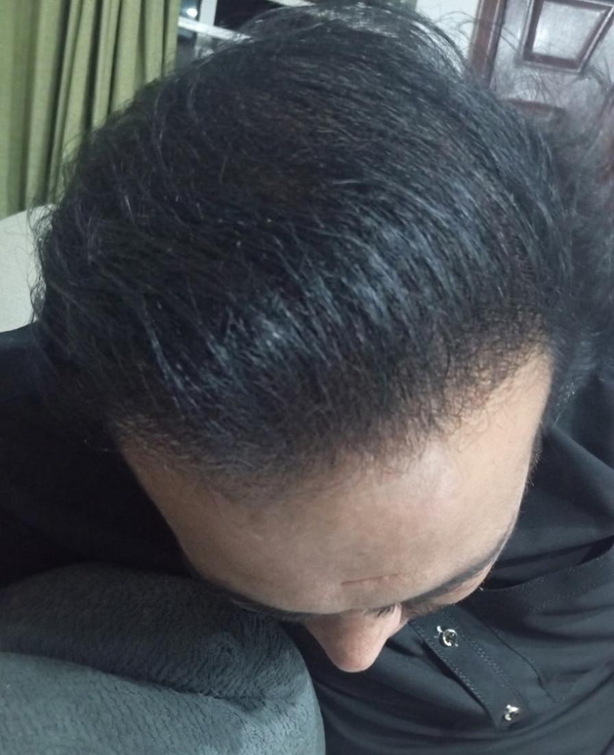 After hair result